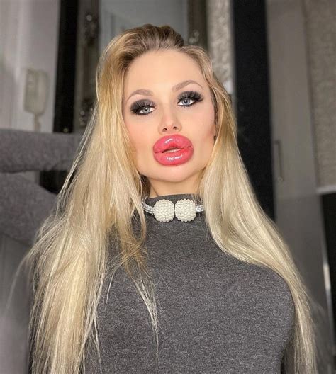 Botox Lips Huge at Dave Jimenez blog