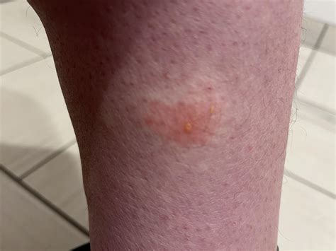 Possible bug bite, continues to swell with yellow liquid leaking out. Should I seek medical ...