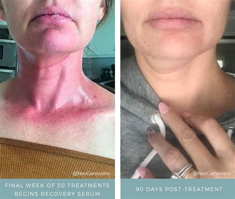 Before + After - NeoGenesis Pro Australia
