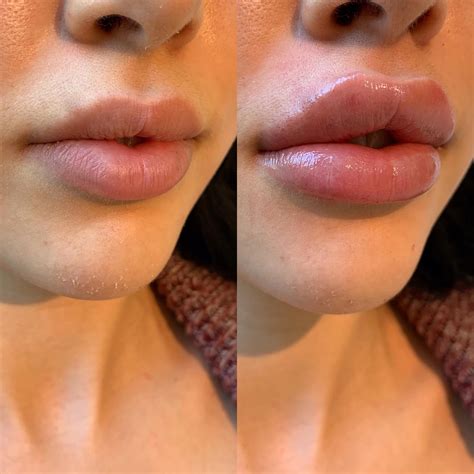 Top 97+ Pictures Before And After Pictures Of Botox Around The Mouth Stunning