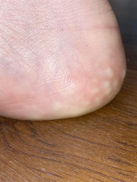 What Is This Bump On The Back Of My Heel? – ZHERSS