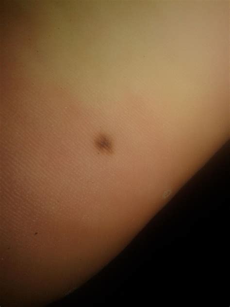 strange mole on the sole of my foot : Melanoma