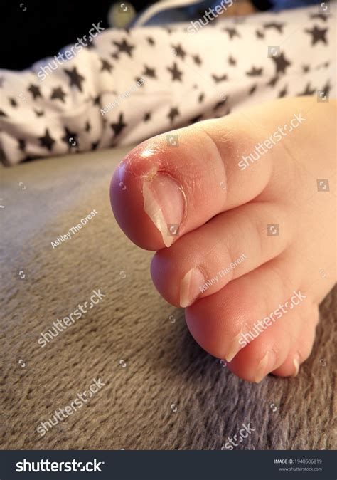 Ingrown Toe Nail Mild Infection On Stock Photo 1940506819 | Shutterstock