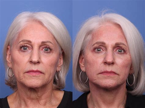 CO2 Laser Resurfacing (under anesthesia) Before and After Pictures Case 447 | Scottsdale ...