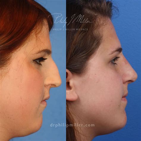 Nose Job Definition at Phillip Dorsey blog