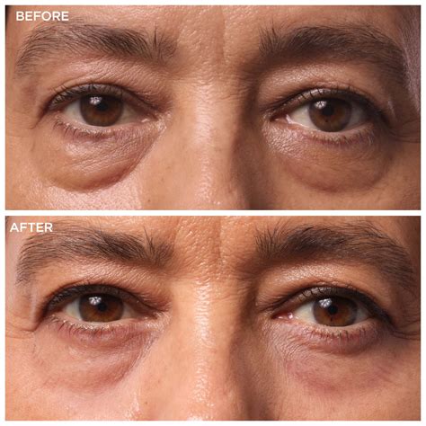 Under Eye Bags: A Plastic Surgeon Weighs In | IT Cosmetics