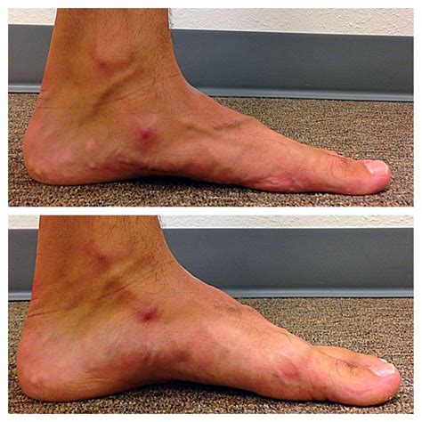 Fix arch pain in foot - squaredroc