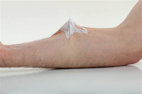 Infiltration Vs Phlebitis