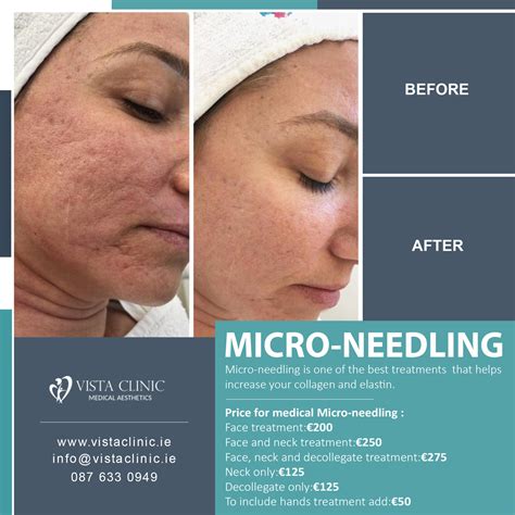 Transform Your Skin with Micro-Needling at Vista Clinic: Advanced Face and Neck Treatment for ...