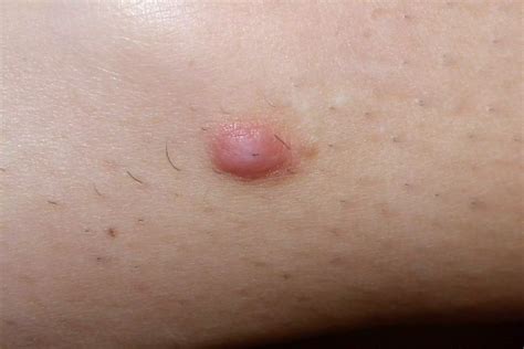 When to Worry About a Lump Under the Skin: 12 Causes