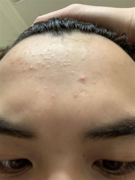 [Skin Concerns] How do I get rid of these small bumps on my forehead? : r/SkincareAddiction