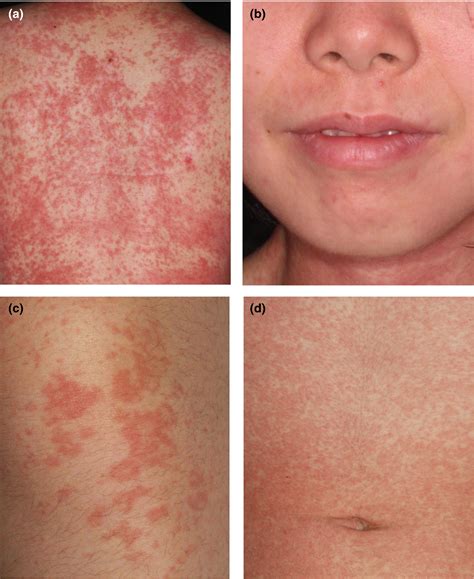 Beginning Lamictal Rash