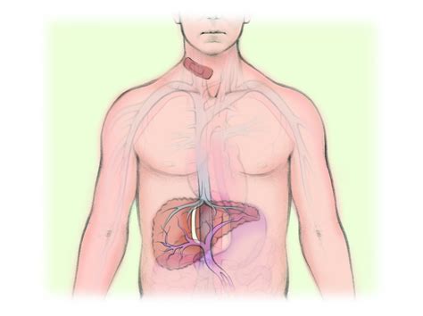 Transjugular intrahepatic portosystemic shunt (TIPS) — The Interventional Initiative