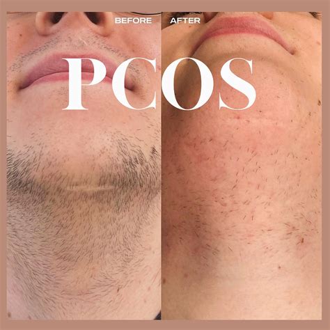 Formato De Rosto Pcos Afax Cápsulas X30 | ASuaFarmáciaOnline