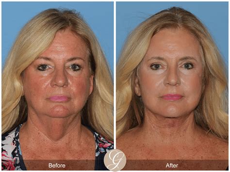 Deep Plane Facelift & Deep Plane Necklift Case 2 Before After Photos Orange County