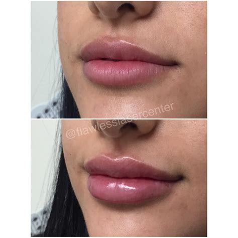 Lip Filler Vermillion Border at Dylan Trouton blog