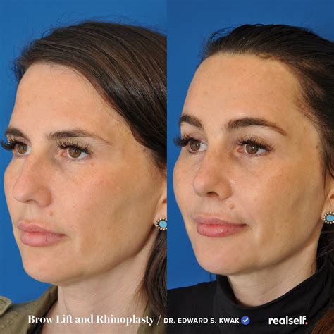 Brow Lift or Eye Lift? How to Know Which Is Right for You, According to ...