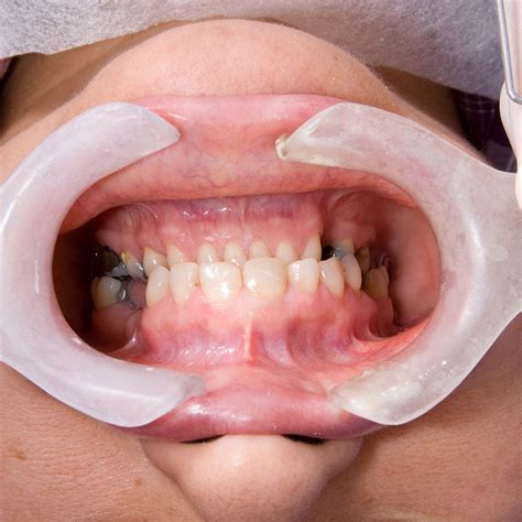 Dental Periodontics Danforth: Save Your Smile with Expert Gum Care