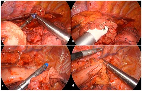 Surgical Technique and Implementation of Total Minimally Invasive (Laparo-Thoracoscopic) Ivor ...