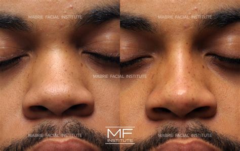 Your Top Non Surgical Nose Job Questions, Answered Mabrie Facial Institute Mabrie Facial Institute