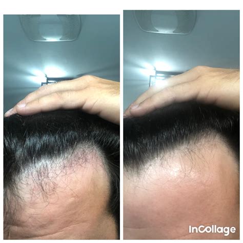 Microneedling ruined my hairline or is this supposed to get better ??? First pic is now second ...