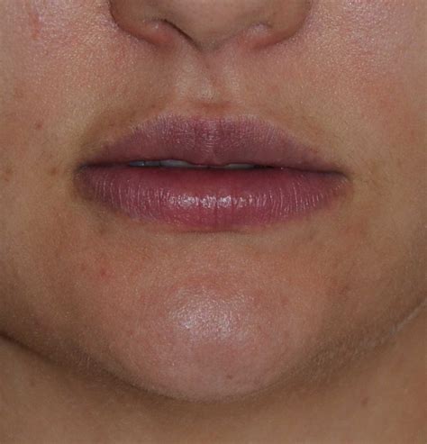 Perma Lip Augmentation Seattle Bellevue