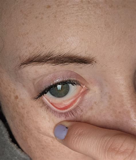 Iron Deficiency Eyes at Kathleen Andrews blog