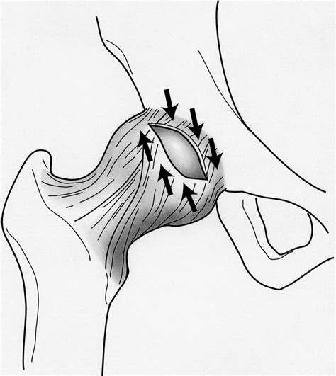 Arthroscopic Capsulotomy, Capsular Repair, and Capsular Plication of ...