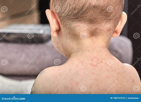 Child Skin Rash Virus at John Mclain blog