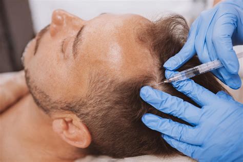 Milwaukee platelet-rich plasma (PRP) injections for hair loss | Dermatology & Cosmetic Physicians