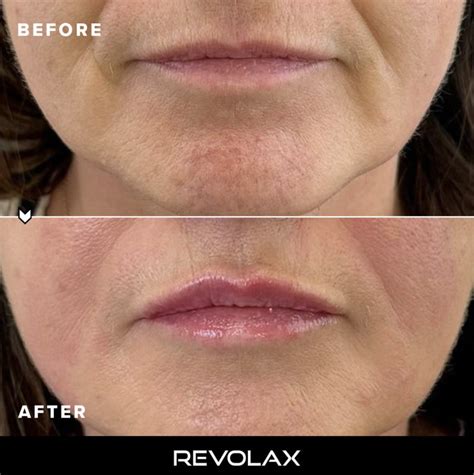 How To Reduce Nasolabial Folds | Blog | REVOLAX