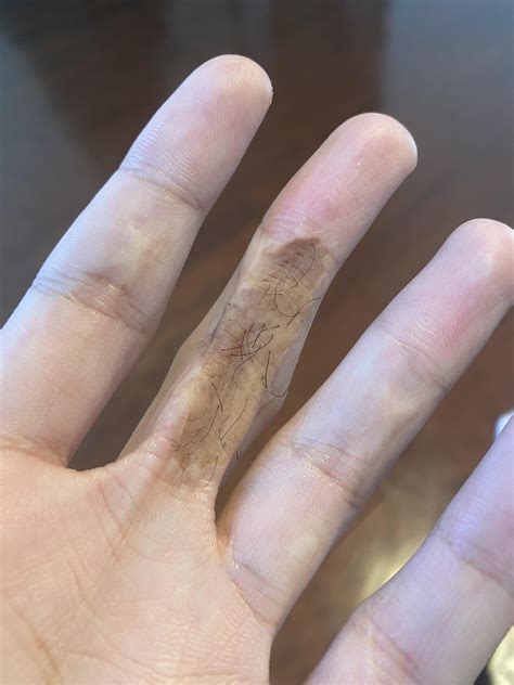 Hawkins v. McGee (1929) : r/LawSchool