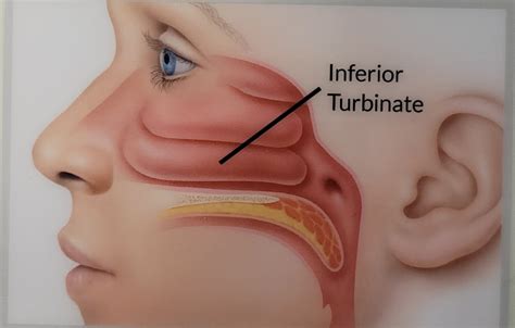 Nasal Turbinates Hypertrophy