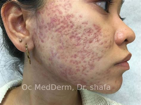 Cystic Acne Scars