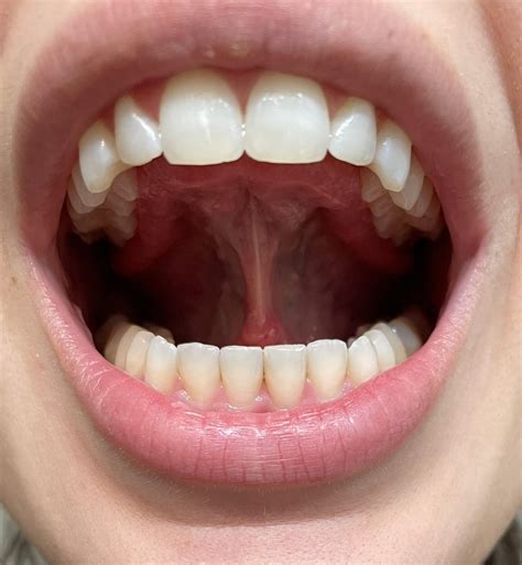 Tongue tie or normal? : r/orthotropics - ankyloglossia vs normal tongue