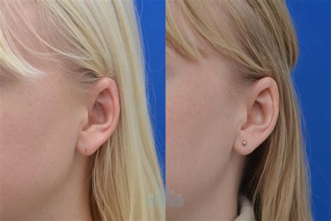 Earlobe Repair Before and After Pictures Case 57 | Charlotte, NC | Dilworth Facial Plastic Surgery