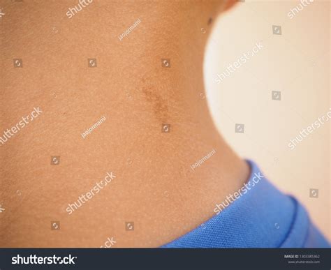 Dark Brow Birthmark Cafe Au Lait Foto Stok 1303385362 | Shutterstock