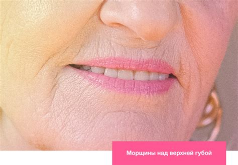 Кисетные морщины над верхней губой: как избавиться