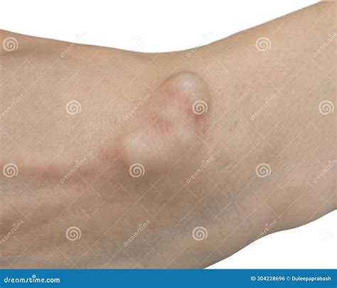 Lump Under Skin On Hand at James Tarvin blog