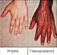 Гемохроматоз :: Симптомы, причины, лечение и шифр по МКБ-10.