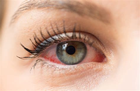 10 Causes & Treatments for Eye Redness | Eye Wellness