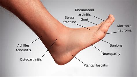 Foot pain types, chart, and causes