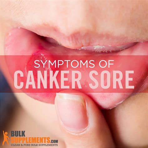 Canker Sore Spreadable