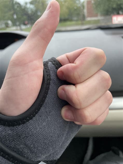 I’m still in! It’s just a sprain, meaning my tendons and ligaments and ...