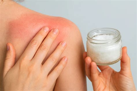 Can Coconut Oil Help Sunburn? Dermatologists Reveal Truth