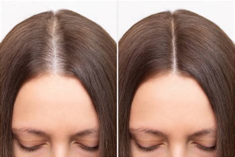 Thinning Hair vs Normal Hair Parting: Differences & Signs to Look For ...