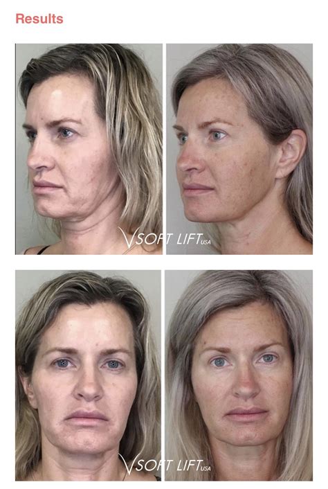 PDO Thread Face Lift | Azani Medical Spa