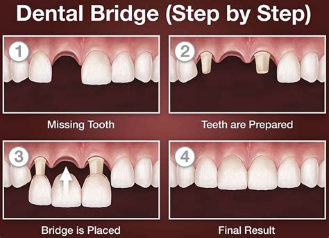 Dental Implant Bridge Procedure at Adam Talbert blog