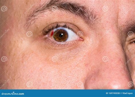 Sharp Pain Eye Blood Vessel Burst at Odessa Francis blog