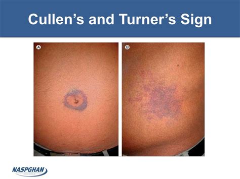 PPT - Pediatric Pancreatitis Presentation and Management Guidelines ...